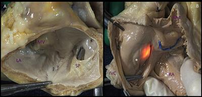 Comparative Anatomy of Mitral and Tricuspid Valve: What Can the Interventionlist Learn From the Surgeon